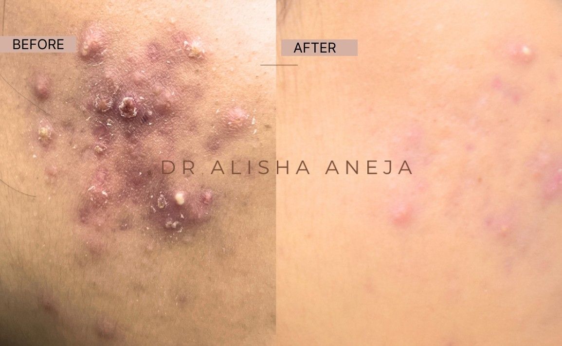 Acne results -100kb