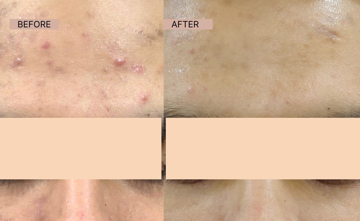 Acne results 11-100kb