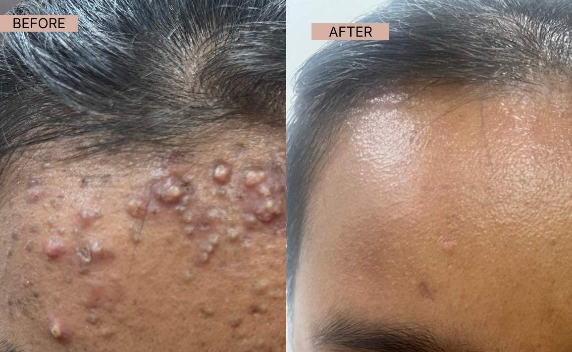 Acne results 5-100kb