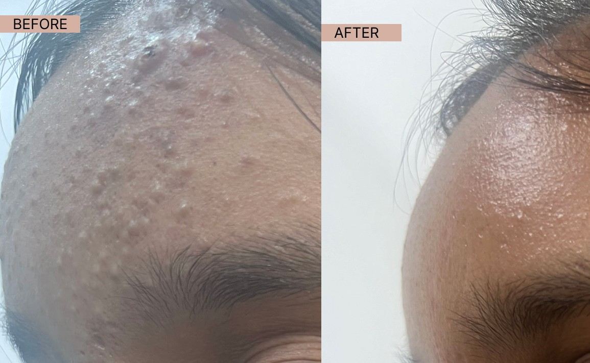 Acne results 6-100kb