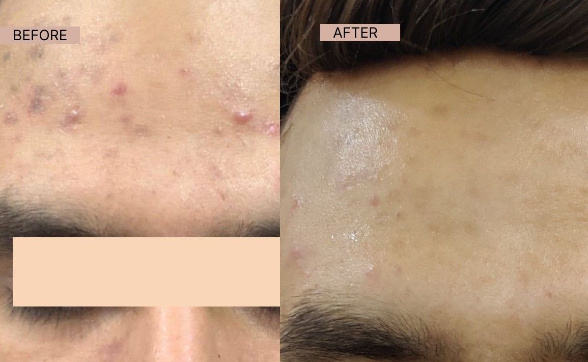 Acne results 7-100kb