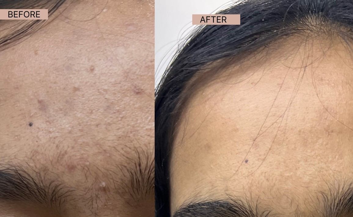 Acne results 8-100kb