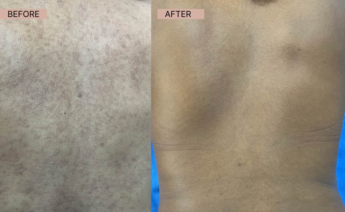 Acne results 12-100kb