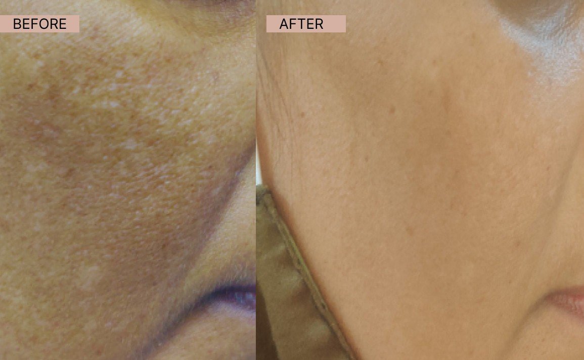 Acne results 14-100kb