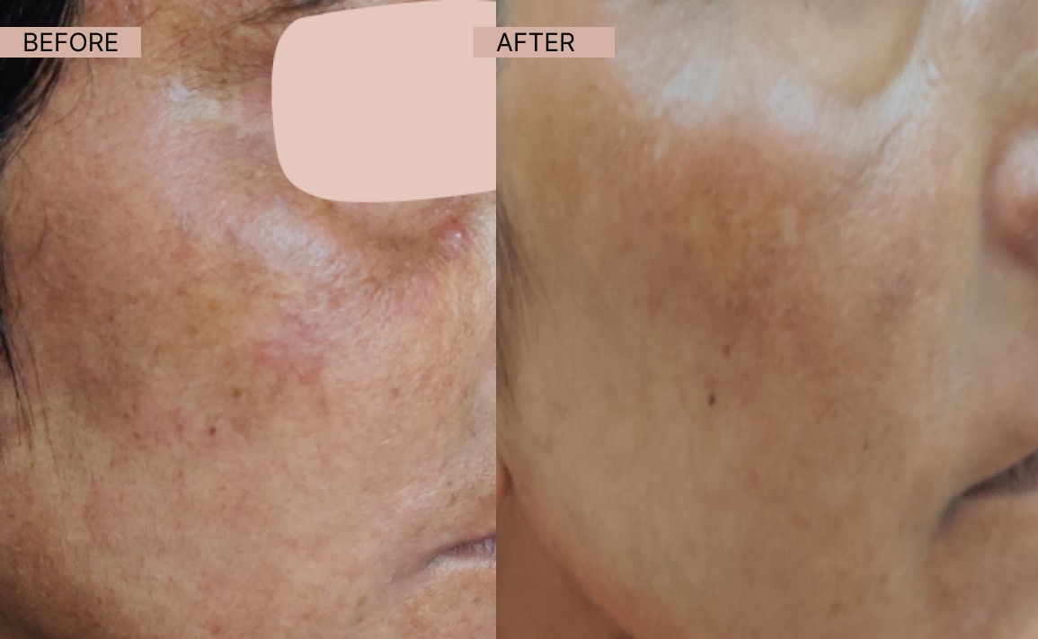 Acne results 15-100kb (1)