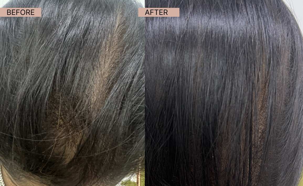 Acne results 17-100kb