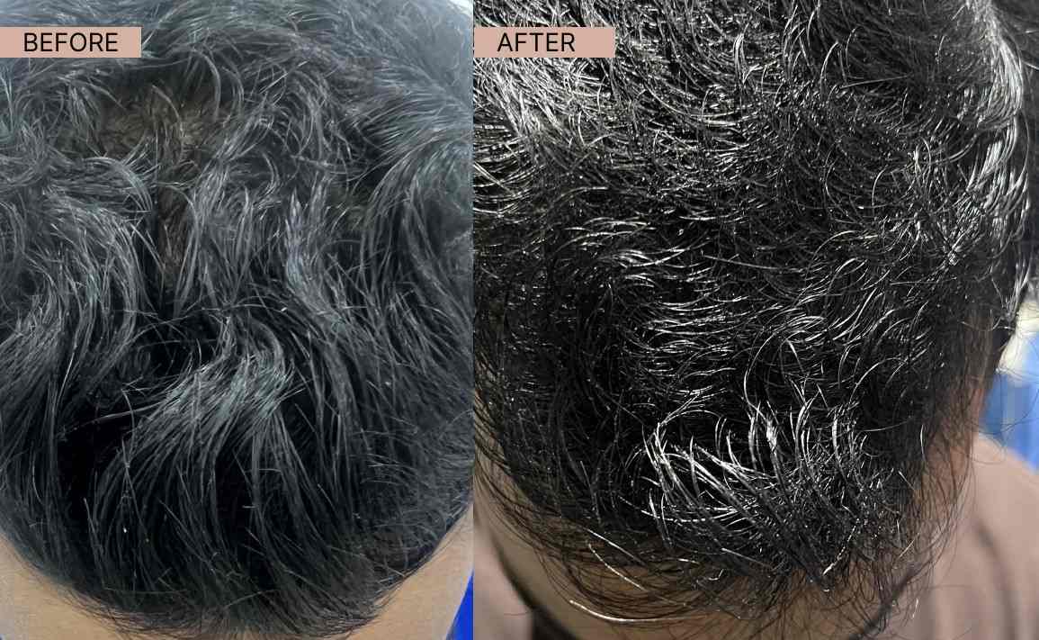 Acne results 18-100kb