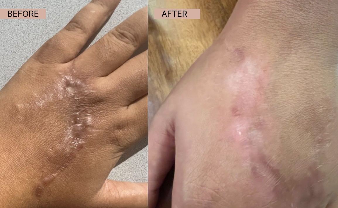 Acne results 20-100kb