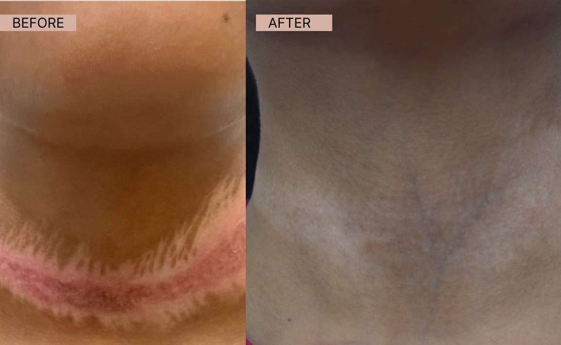 Acne results 21-100kb