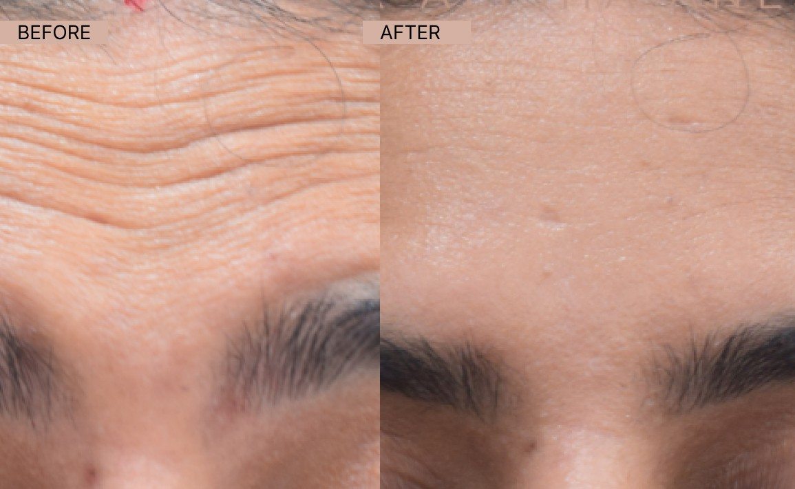 Botox results-100kb