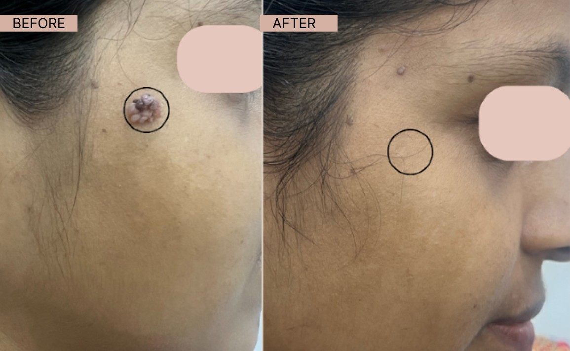 Warts results 1-100kb