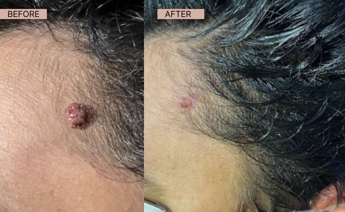 Warts results-100kb